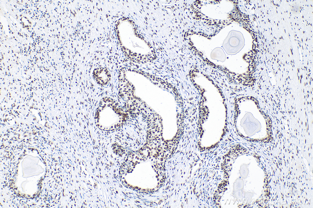 IHC staining of human prostate cancer using 81871-1-RR