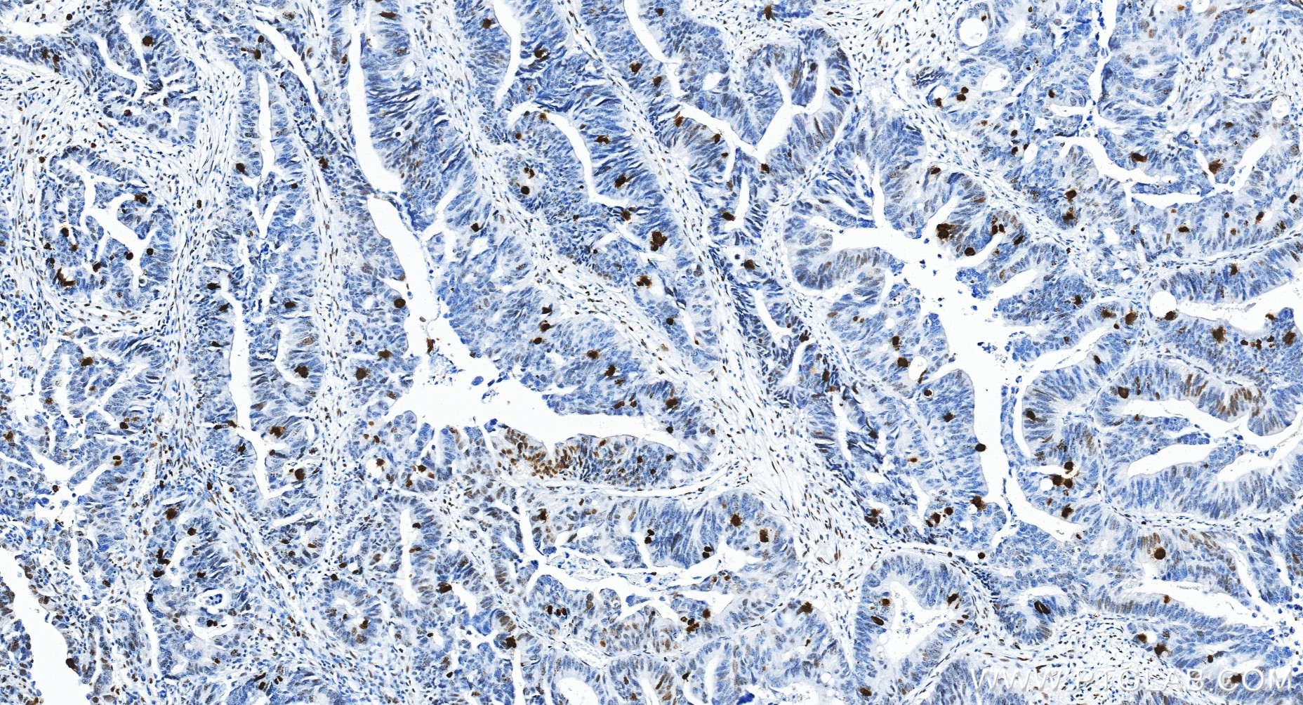 Immunohistochemical analysis of paraffin-embedded human colon cancer tissue slide using 82828-10-RR (Phospho-Histone H3 (Ser10) antibody) at dilution of 1:20000 (under 20x lens). Heat mediated antigen retrieval with Tris-EDTA buffer (pH 9.0). IHC staining of human colon cancer using 82828-10-RR