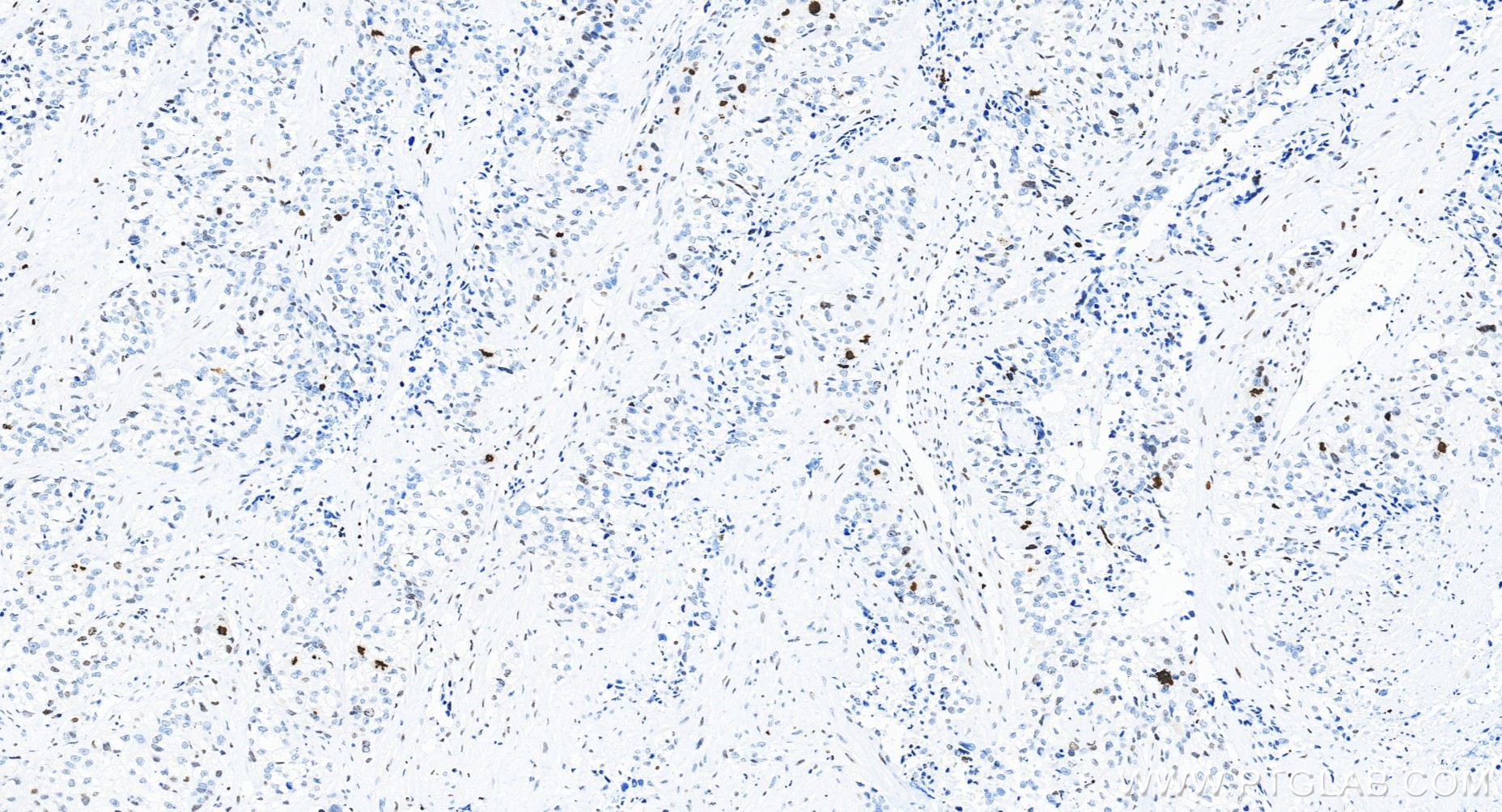 Immunohistochemical analysis of paraffin-embedded human ovary cancer tissue slide using 82828-10-RR (Phospho-Histone H3 (Ser10) antibody) at dilution of 1:20000 (under 20x lens). Heat mediated antigen retrieval with Tris-EDTA buffer (pH 9.0). IHC staining of human ovary cancer using 82828-10-RR