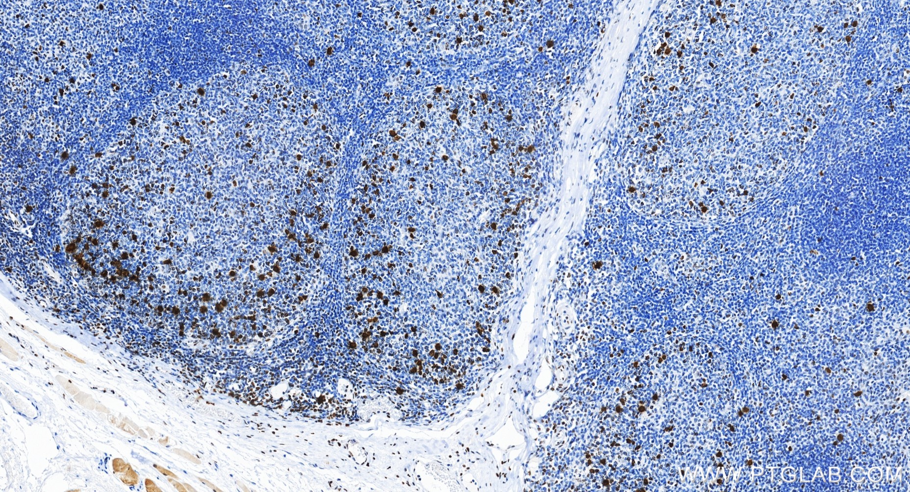 Immunohistochemical analysis of paraffin-embedded human tonsillitis tissue slide using 82828-10-RR (Phospho-Histone H3 (Ser10) antibody) at dilution of 1:20000 (under 20x lens). Heat mediated antigen retrieval with Tris-EDTA buffer (pH 9.0). IHC staining of human tonsillitis using 82828-10-RR