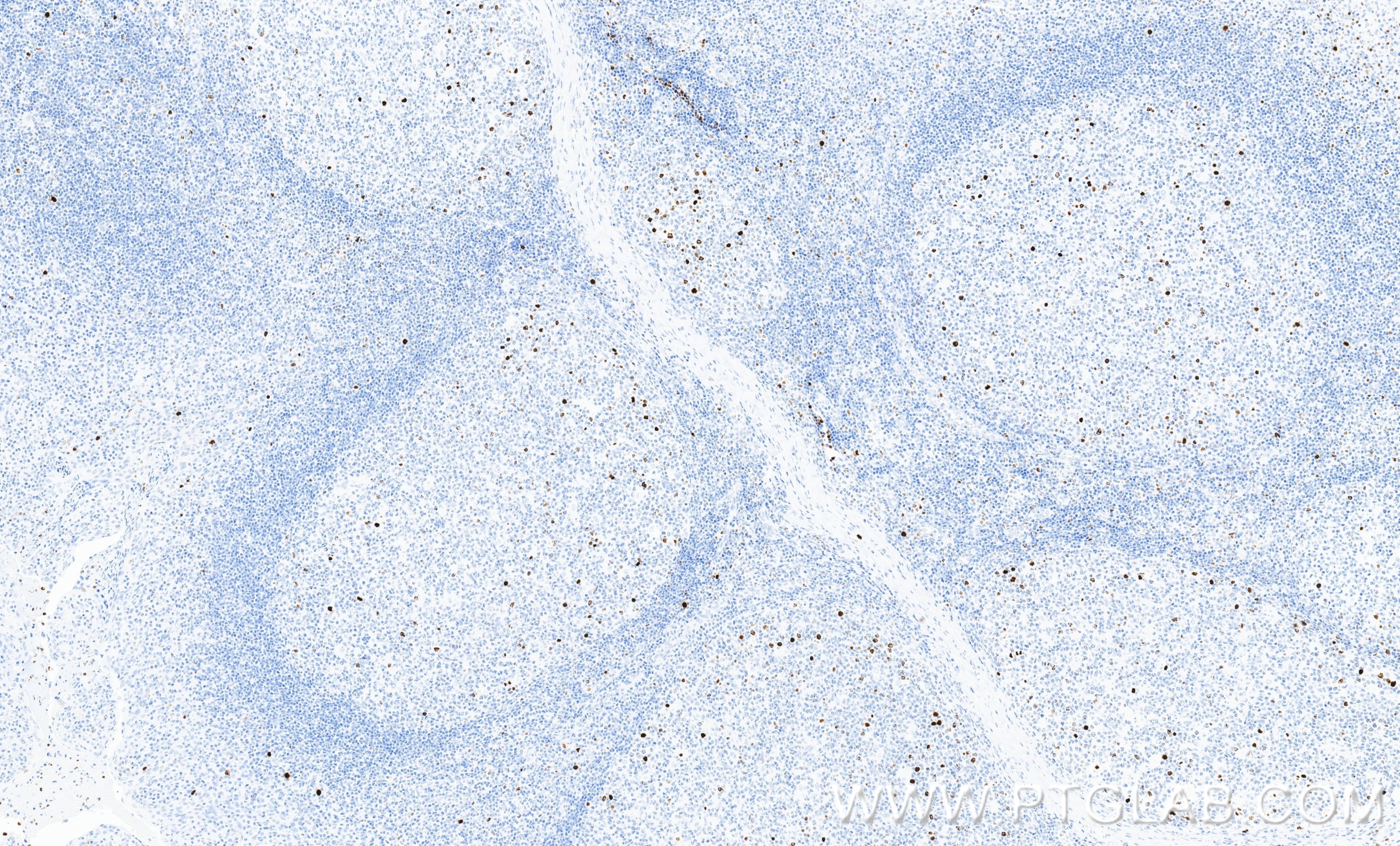 IHC staining of human tonsillitis using 82828-16-RR IHC staining of human tonsillitis using 82828-16-RR