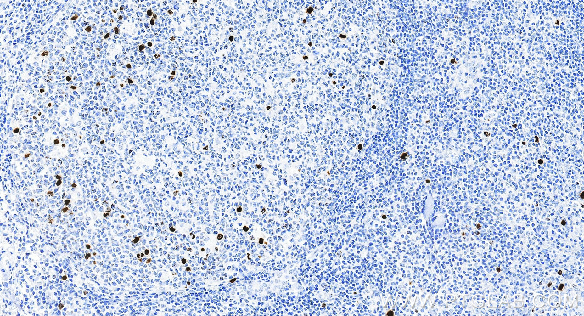 IHC staining of human tonsillitis using 82828-18-RR IHC staining of human tonsillitis using 82828-18-RR