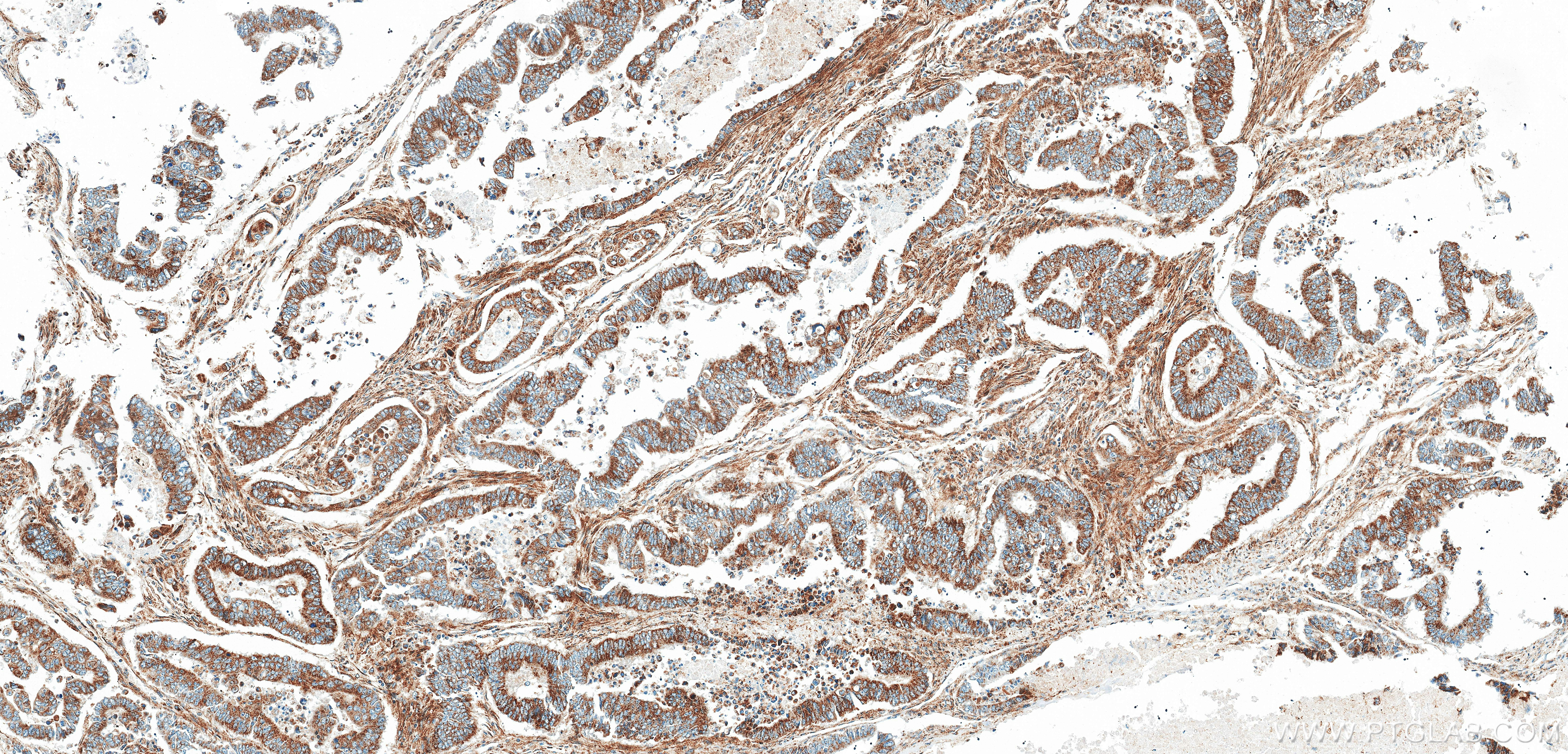 IHC staining of human colon cancer using 85753-1-RR (same clone as 85753-1-PBS)