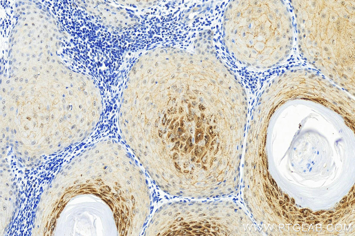 IHC staining of human skin cancer using 82349-1-RR