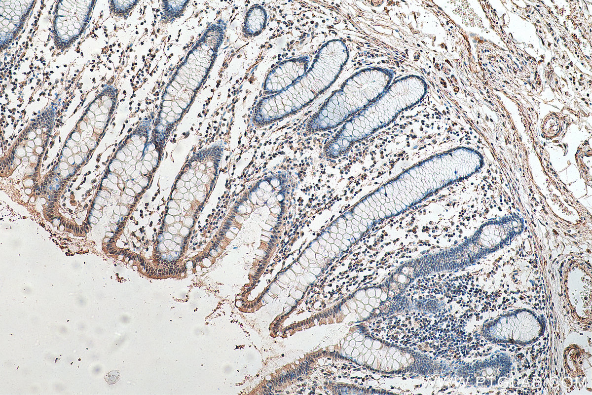 IHC staining of human colon cancer using 67900-1-Ig