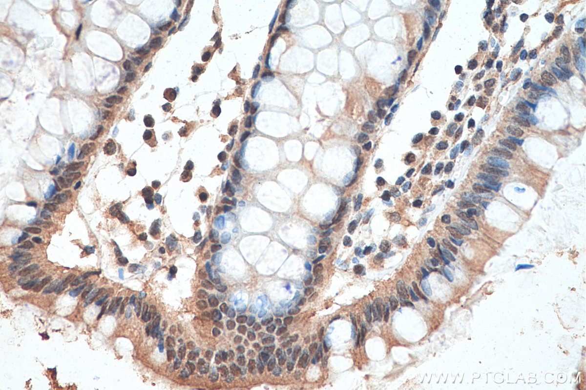 IHC staining of human colon cancer using 67900-1-Ig