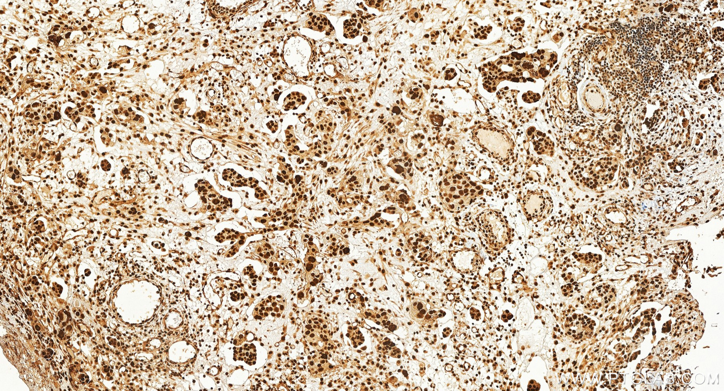 IHC staining of human ovary cancer using 30376-1-AP IHC staining of human ovary cancer using 30376-1-AP