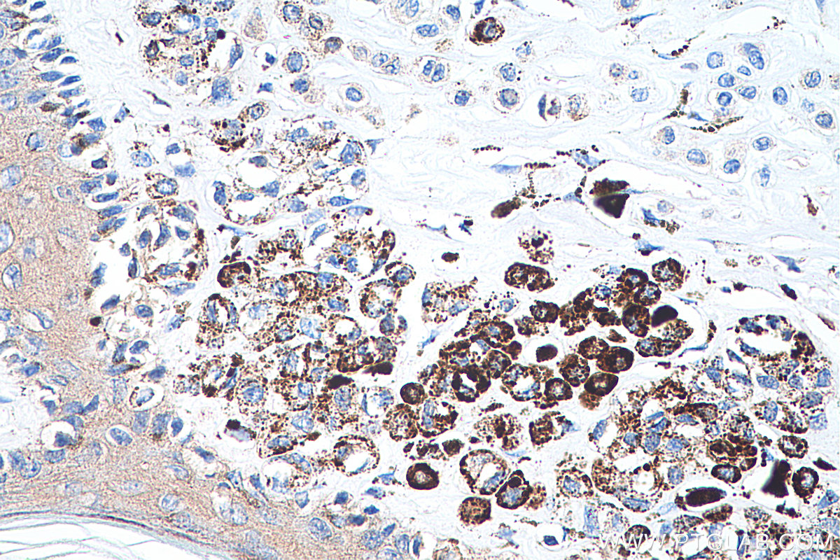 IHC staining of human malignant melanoma using 80108-1-RR (same clone as 80108-1-PBS)