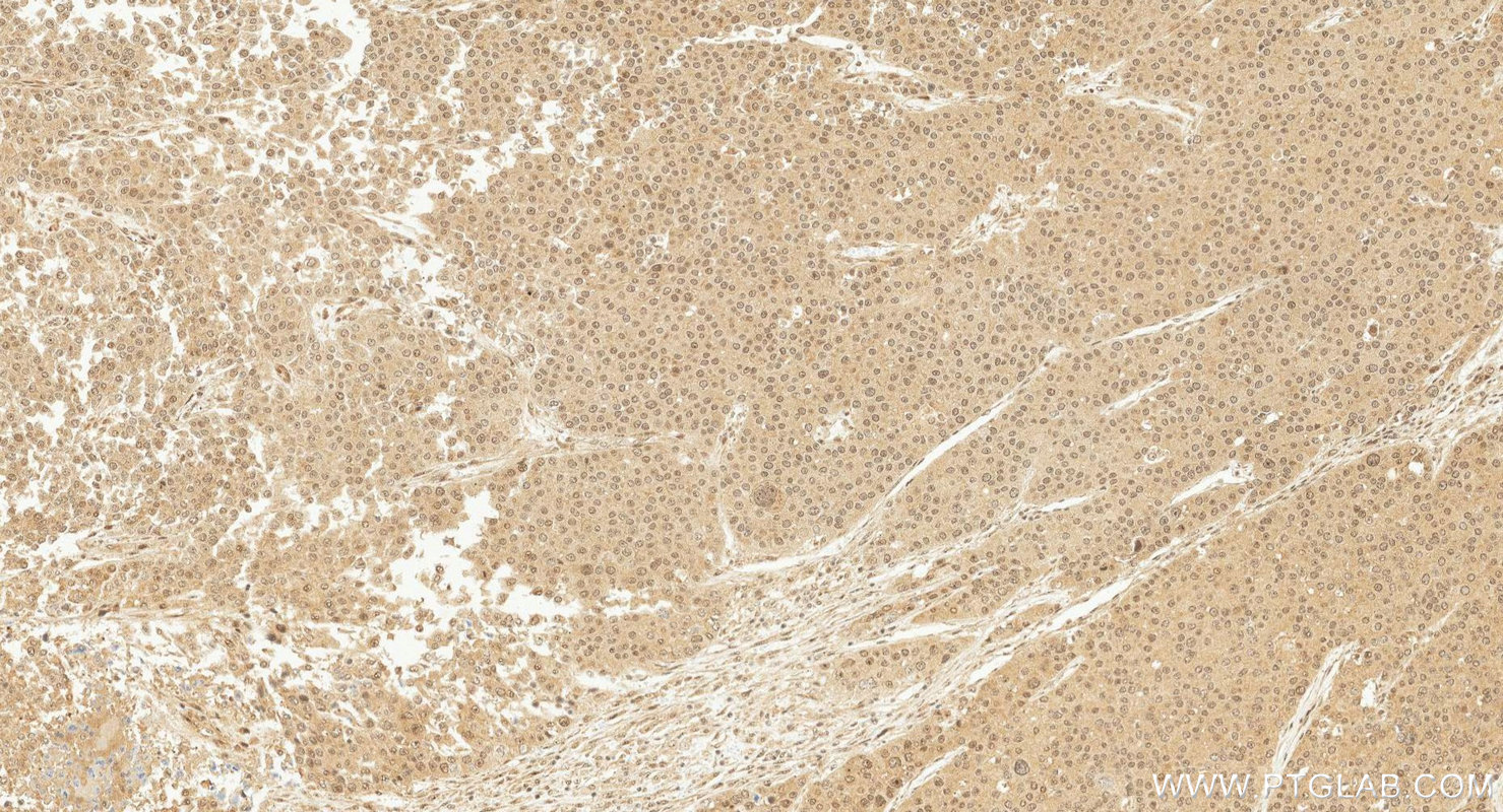 IHC staining of human liver cancer using 80427-2-RR IHC staining of human liver cancer using 80427-2-RR