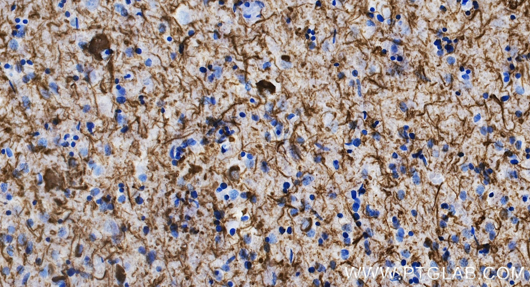 IHC staining of human brain（AD） using 80101-7-RR