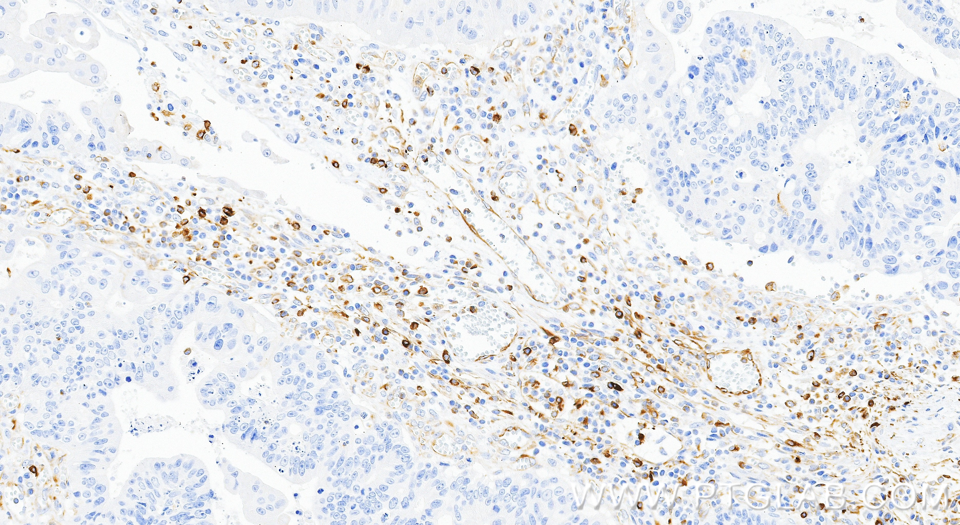 IHC staining of human colon cancer using 87714-1-RR IHC staining of human colon cancer using 87714-1-RR