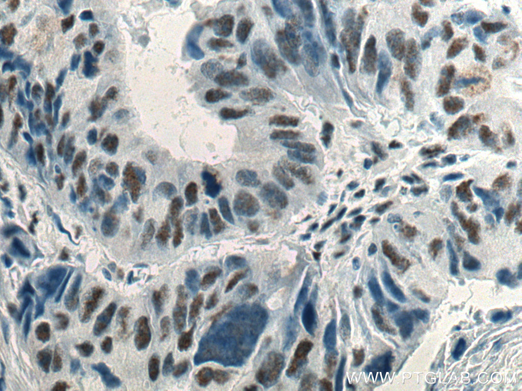 IHC staining of human colon cancer using 67778-1-Ig