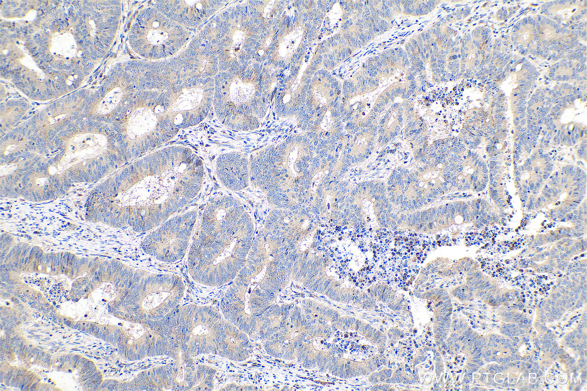 IHC staining of human colon cancer using 55463-1-AP