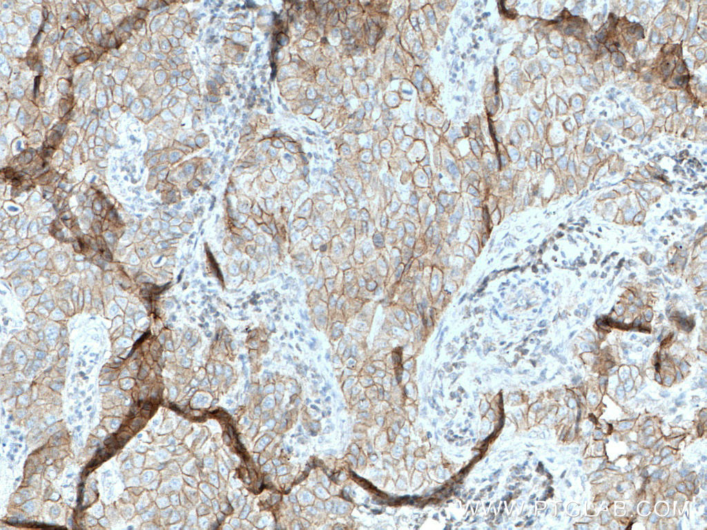 IHC staining of human breast cancer using 66445-1-Ig (same clone as 66445-1-PBS)