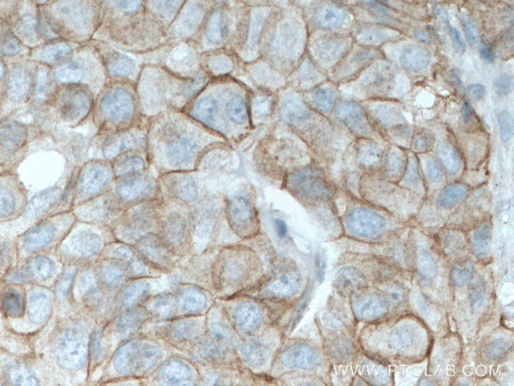 IHC staining of human breast cancer using 66445-1-Ig (same clone as 66445-1-PBS)