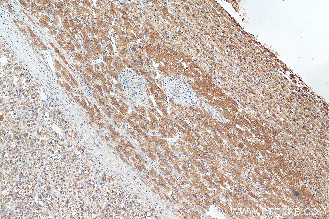IHC staining of human liver cancer using 26768-1-AP