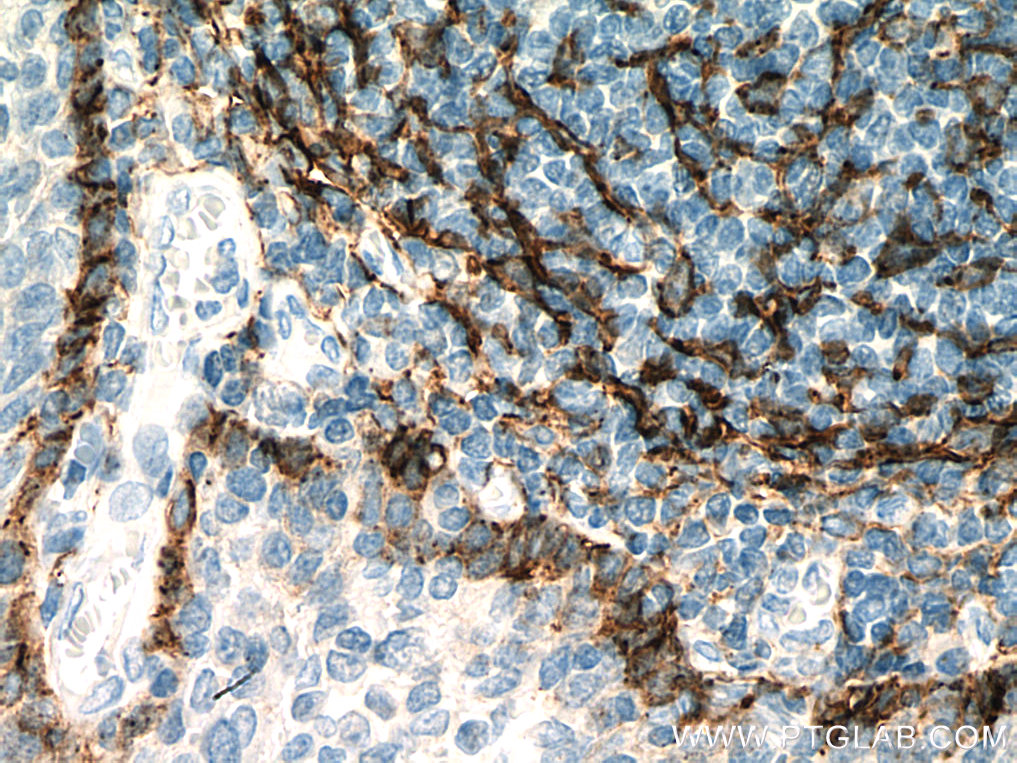 IHC staining of human tonsillitis using 67432-1-Ig (same clone as 67432-1-PBS)