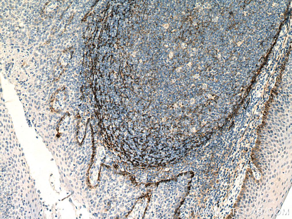 IHC staining of human tonsillitis using 67432-1-Ig (same clone as 67432-1-PBS)