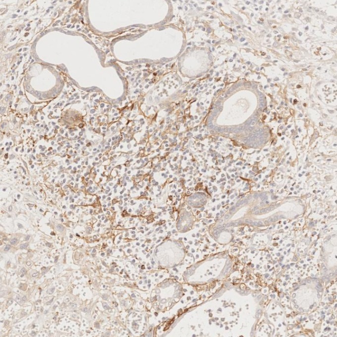 IHC staining of human oesophagus cancer using 67432-1-Ig (same clone as 67432-1-PBS)