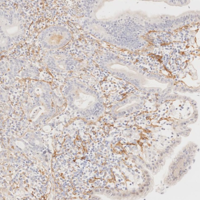 IHC staining of human stomach cancer using 67432-1-Ig (same clone as 67432-1-PBS)