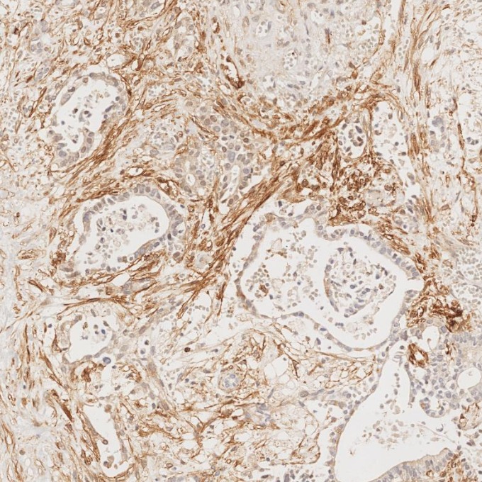 IHC staining of human pancreas cancer using 67432-1-Ig (same clone as 67432-1-PBS)