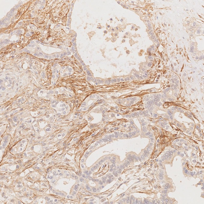 IHC staining of human pancreas cancer using 67432-1-Ig (same clone as 67432-1-PBS)