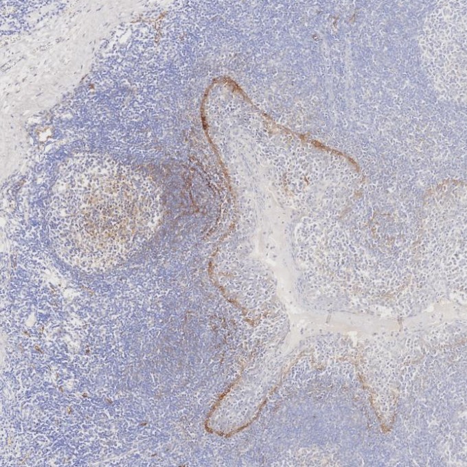 IHC staining of human tonsillitis using 67432-1-Ig (same clone as 67432-1-PBS)