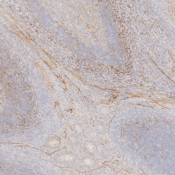IHC staining of human appendicitis using 67432-1-Ig (same clone as 67432-1-PBS)