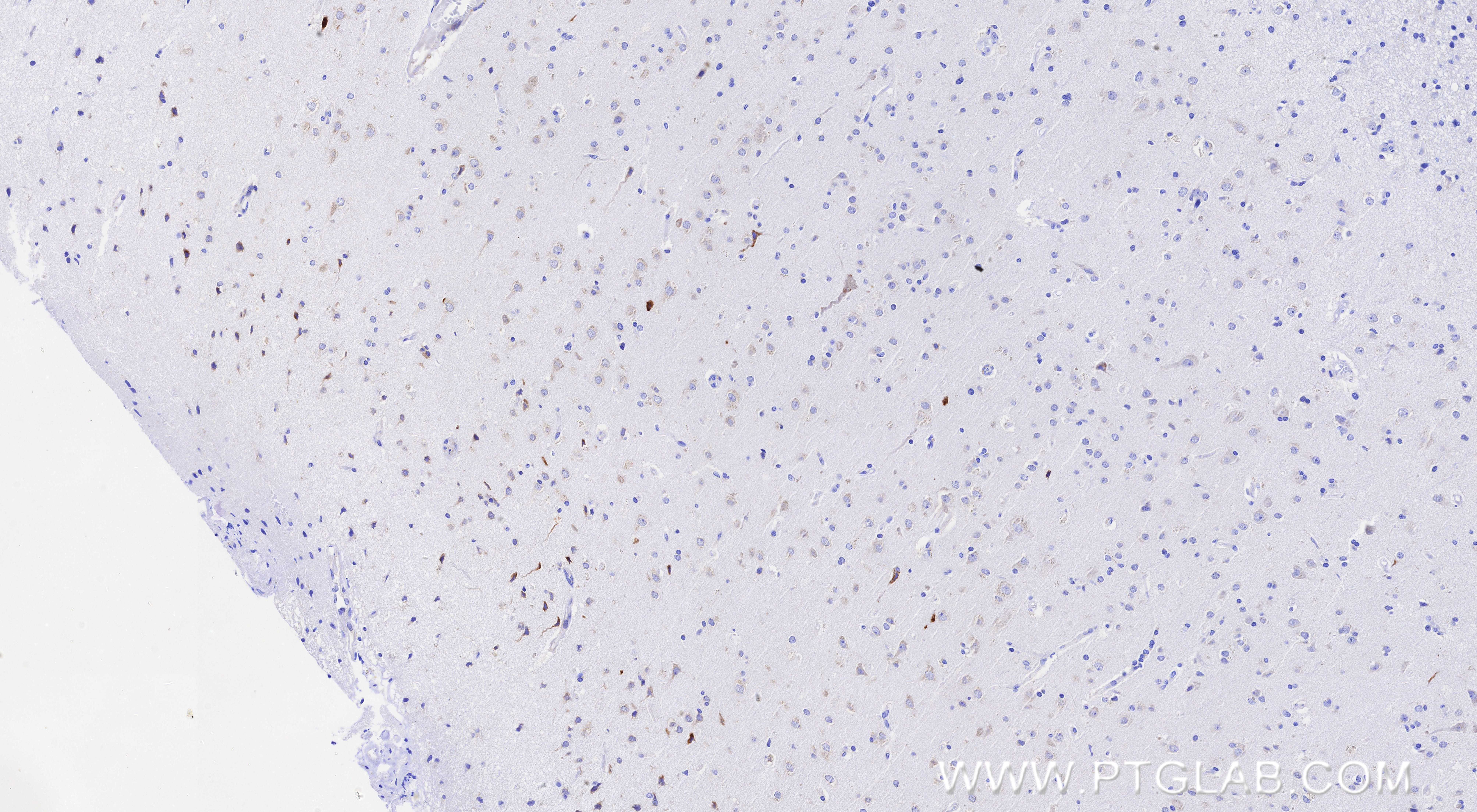 IHC staining of Human brain cancer（Astrocitoma） using 83618-5-RR