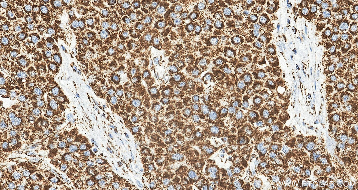 IHC staining of human liver cancer using 88442-1-RR IHC staining of human liver cancer using 88442-1-RR