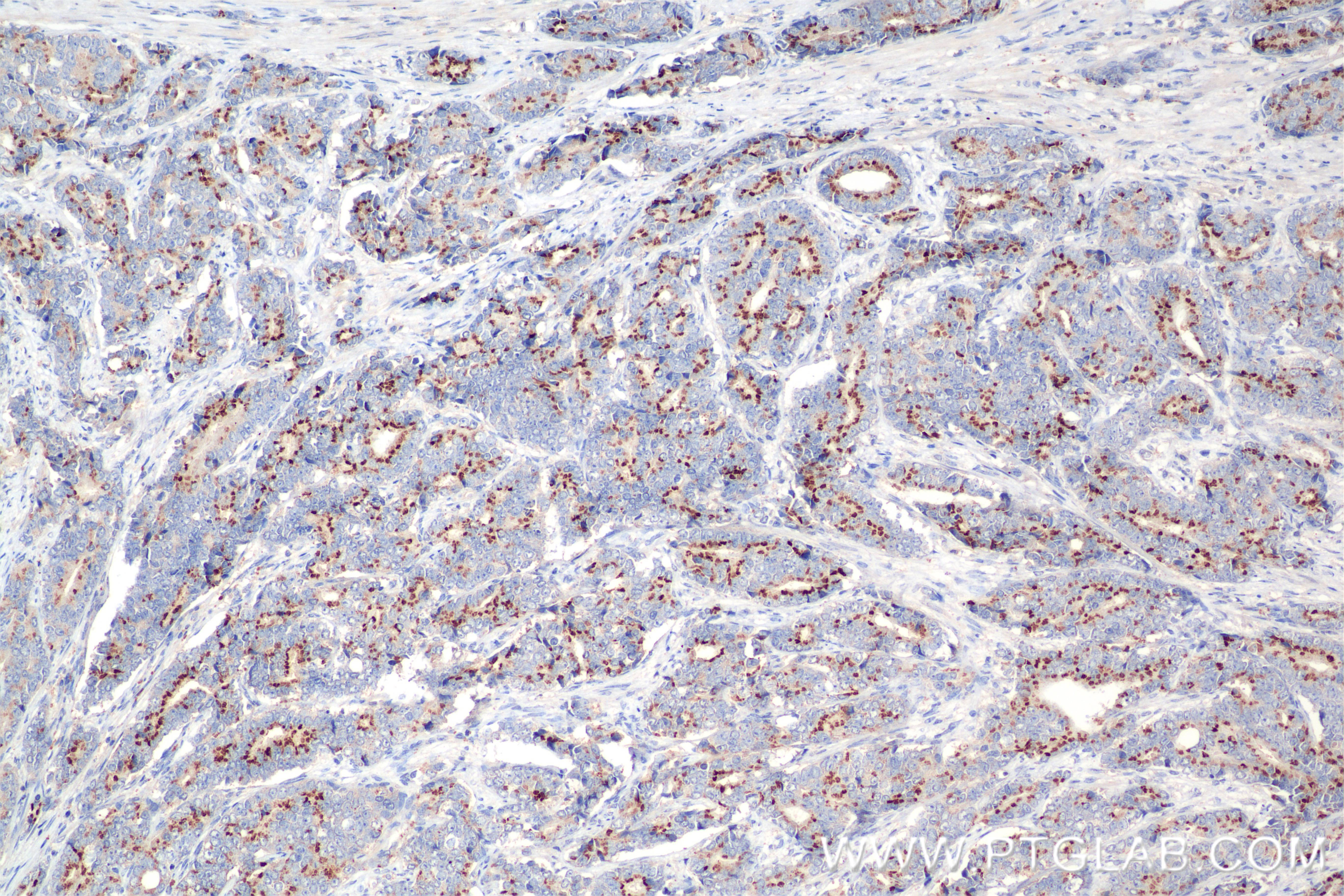 IHC staining of human prostate cancer using 84629-2-RR