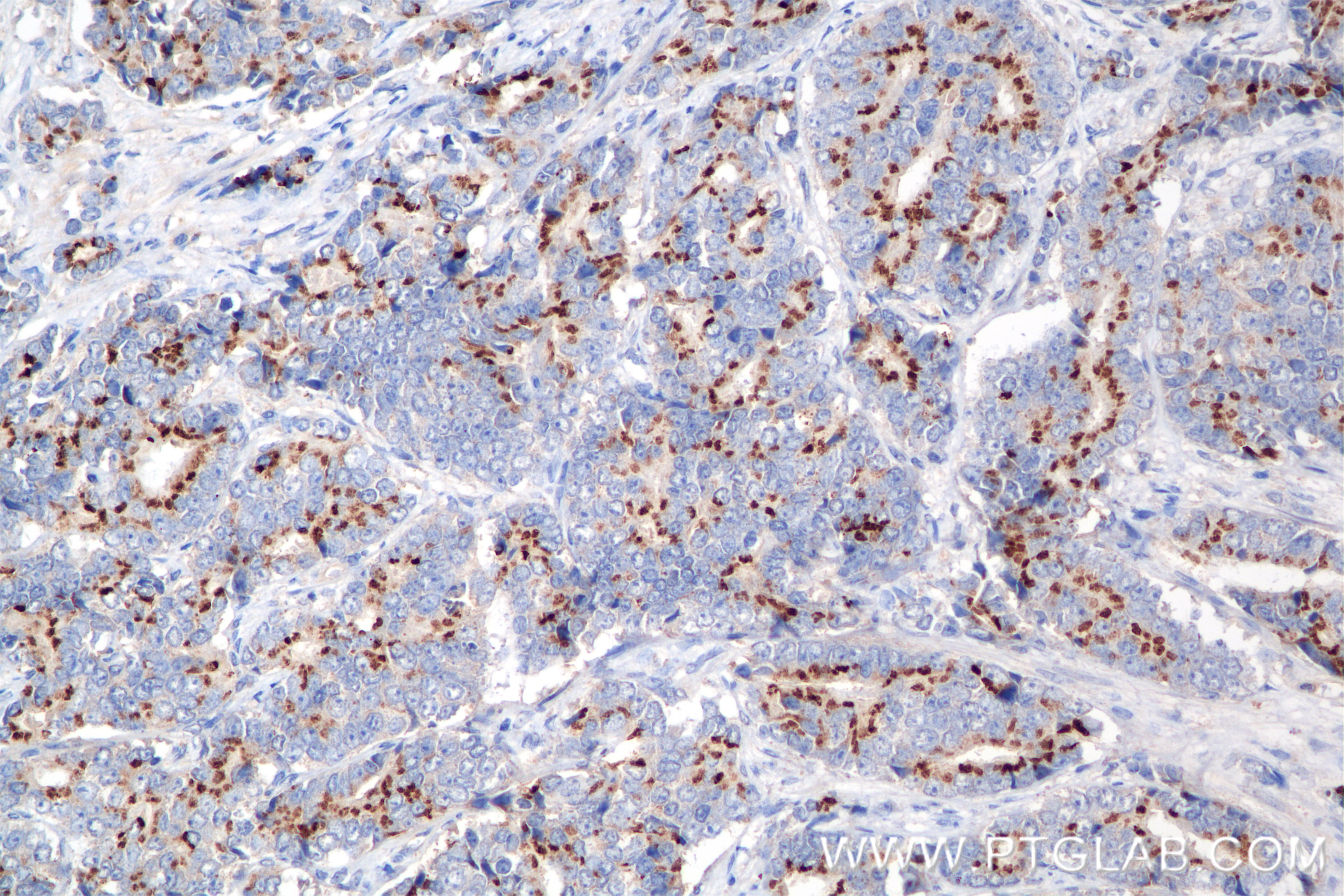 IHC staining of human prostate cancer using 84629-2-RR