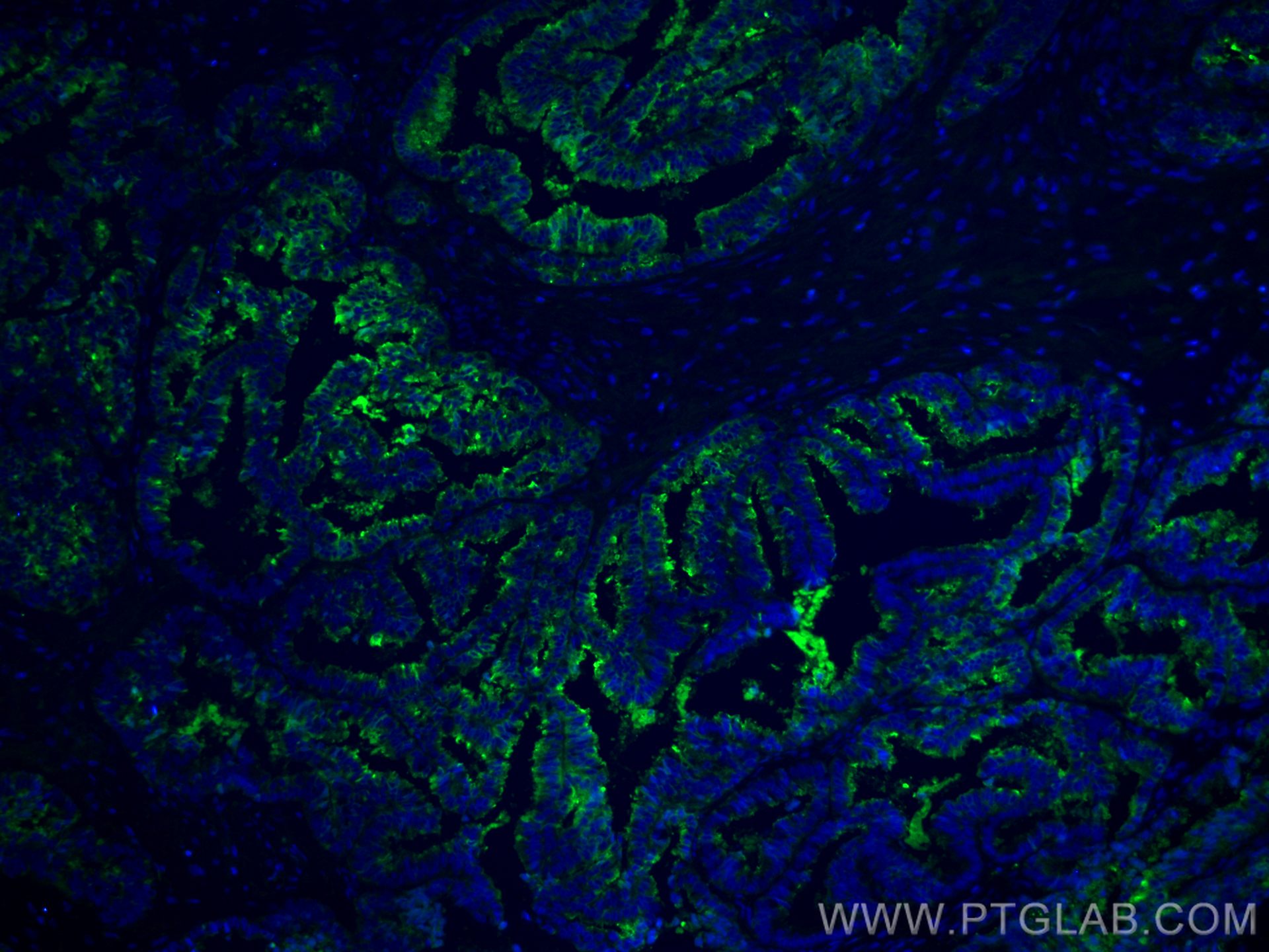 IF Staining of human ovary tumor using CL488-66030