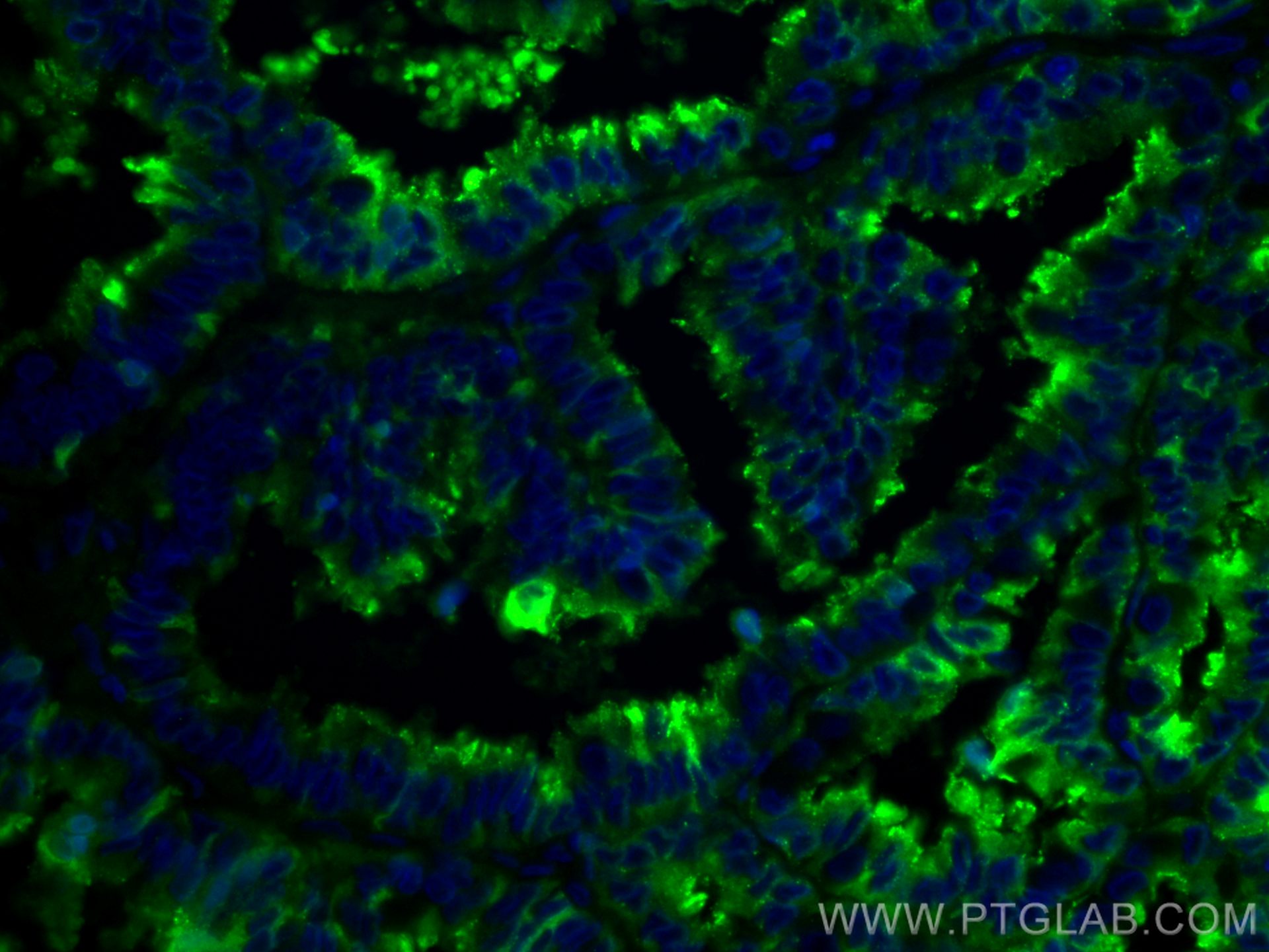 IF Staining of human ovary tumor using CL488-66030