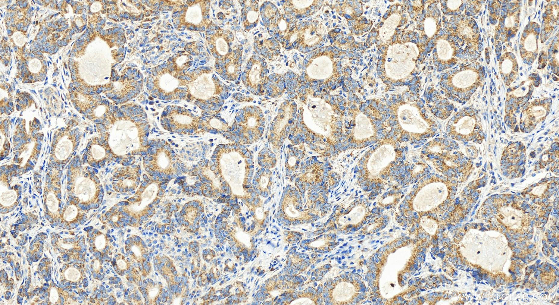IHC staining of human stomach cancer using 15926-1-AP (same clone as 15926-1-PBS)