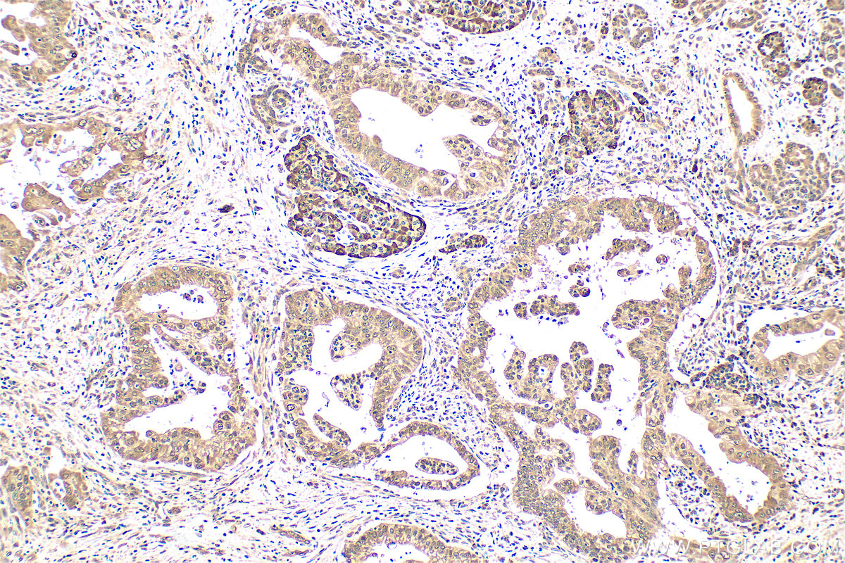 IHC staining of human pancreas cancer using 55326-1-AP (same clone as 55326-1-PBS) IHC staining of human pancreas cancer using 55326-1-AP (same clone as 55326-1-PBS)