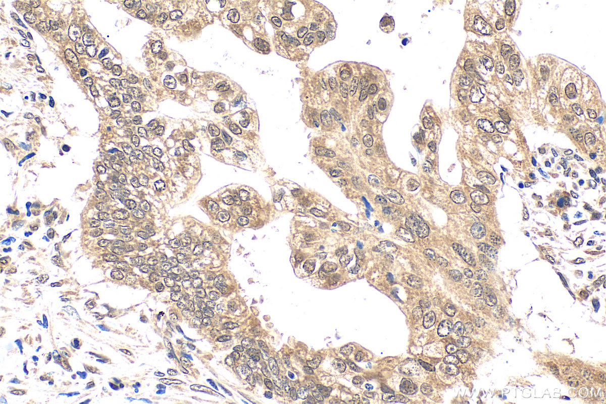 IHC staining of human pancreas cancer using 55326-1-AP (same clone as 55326-1-PBS) IHC staining of human pancreas cancer using 55326-1-AP (same clone as 55326-1-PBS)