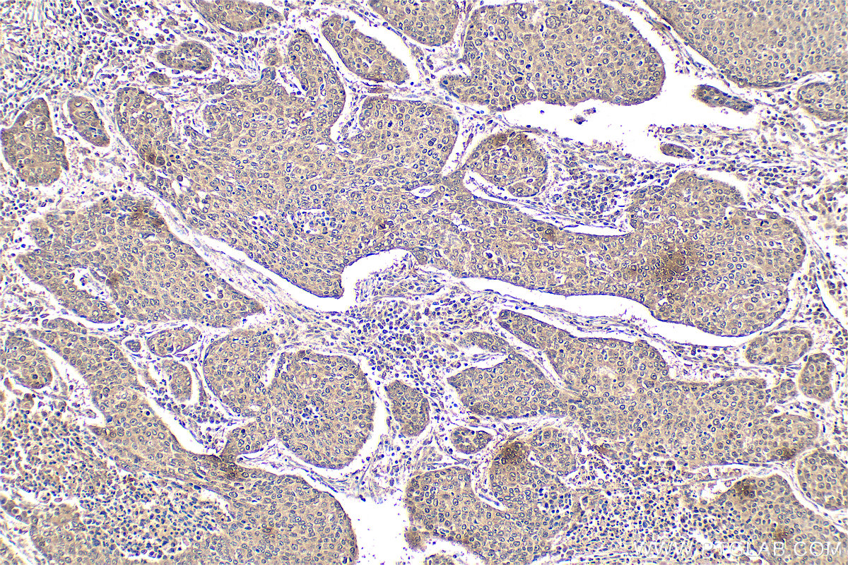 IHC staining of human lung cancer using 55326-1-AP IHC staining of human lung cancer using 55326-1-AP