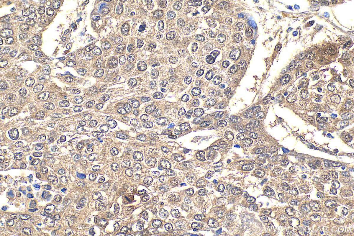 IHC staining of human lung cancer using 55326-1-AP IHC staining of human lung cancer using 55326-1-AP