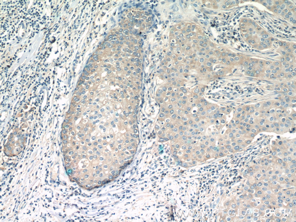 IHC staining of human breast cancer using 16778-1-AP