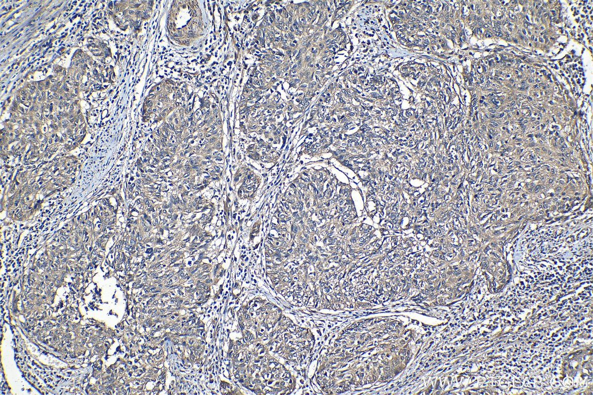 IHC staining of human cervical cancer using 14594-1-AP