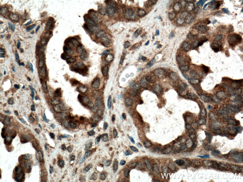 IHC staining of human ovary tumor using 15662-1-AP