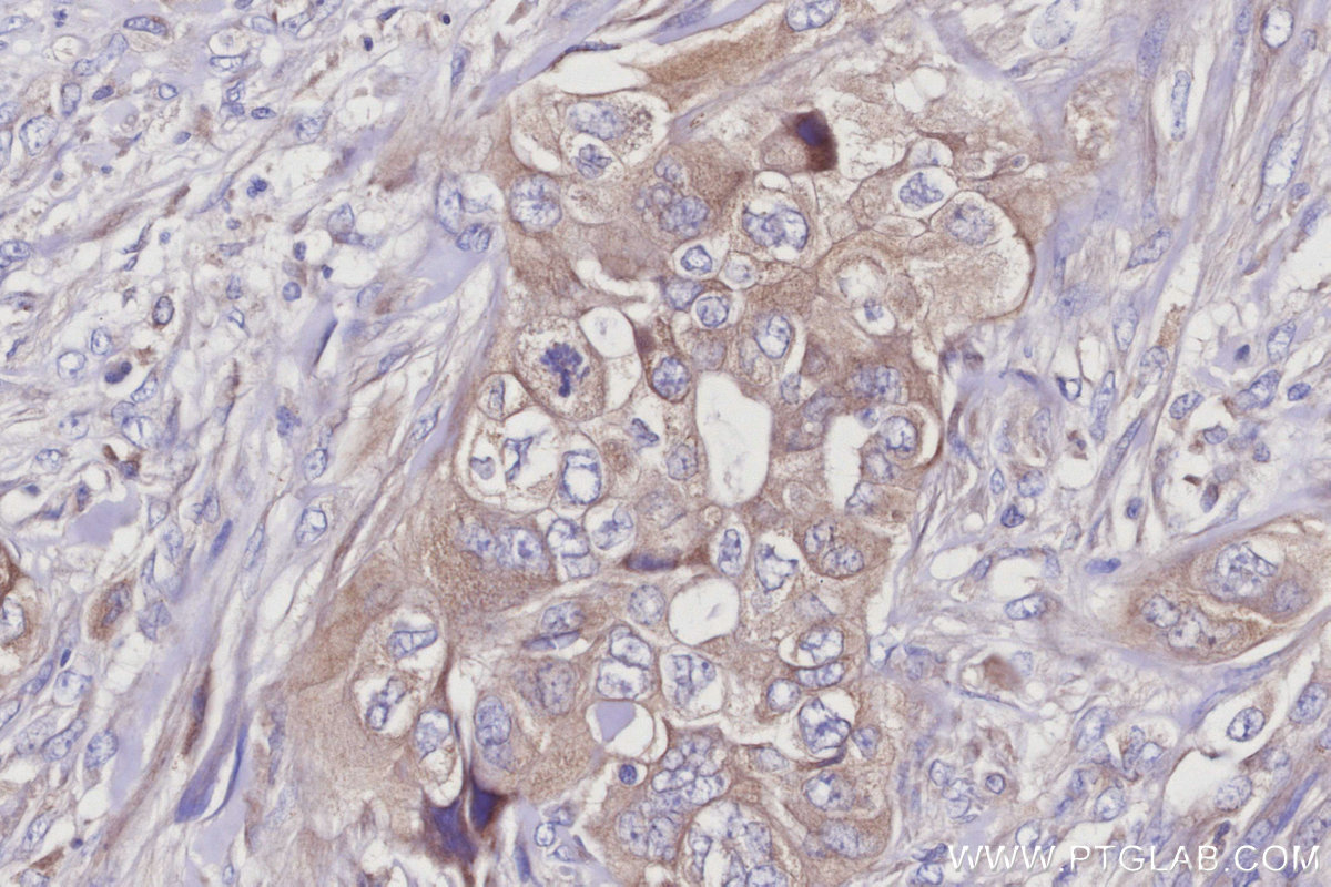 IHC staining of human pancreas cancer using 67659-1-Ig