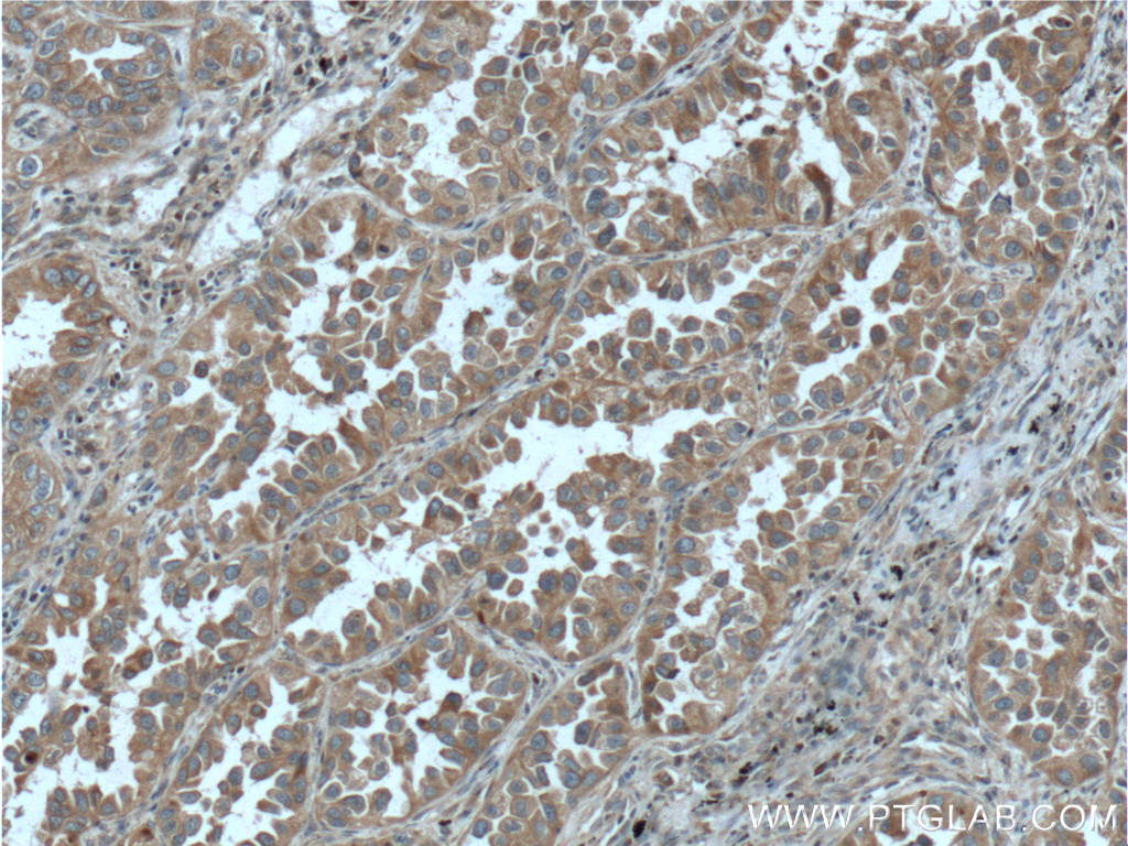 IHC staining of human lung cancer using 11671-1-AP