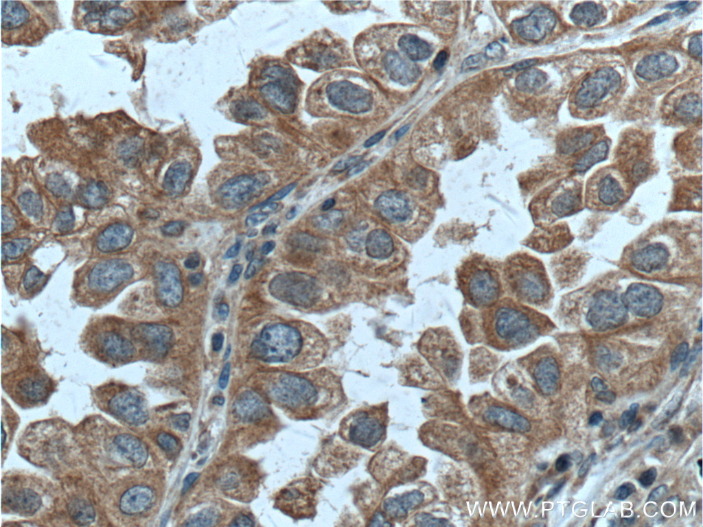 IHC staining of human lung cancer using 11671-1-AP