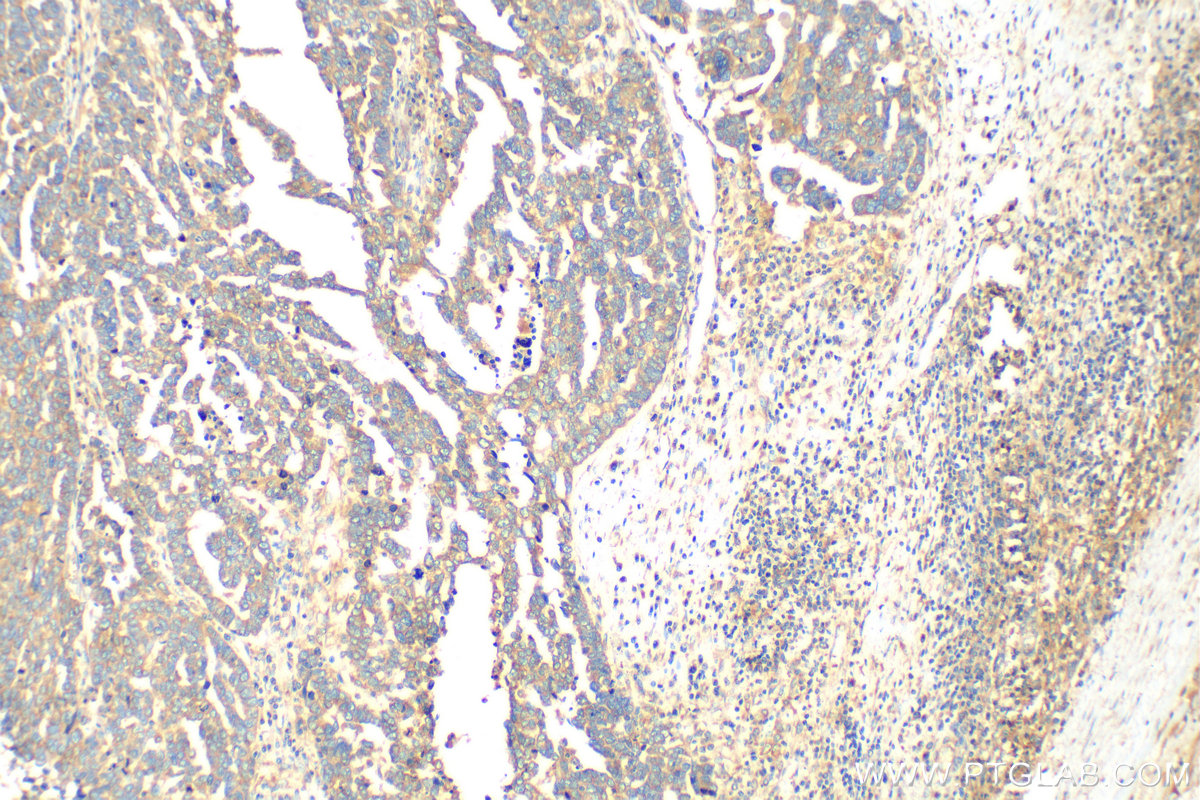 IHC staining of human ovary tumor using 17824-1-AP