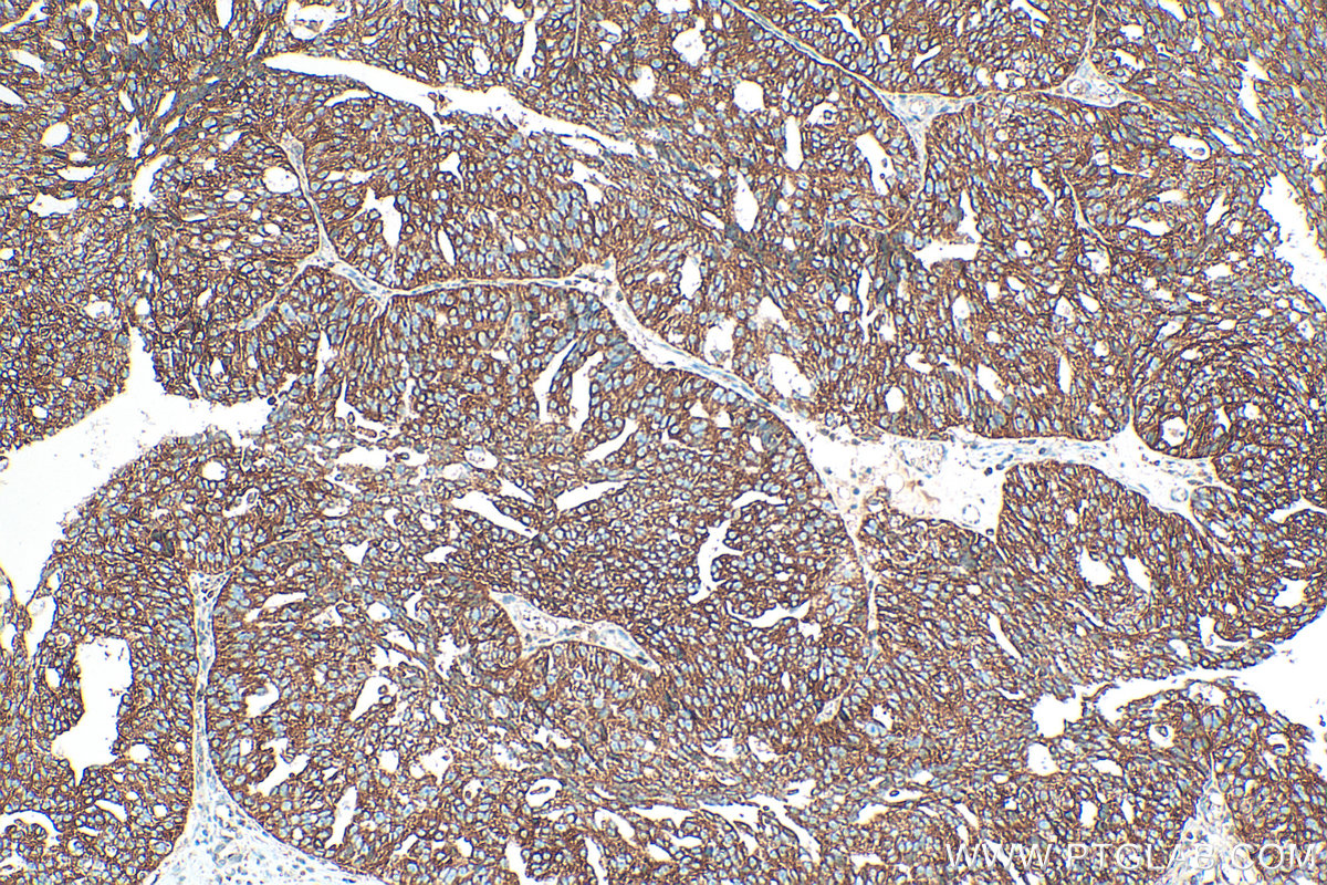 IHC staining of human ovary cancer using 17824-1-AP
