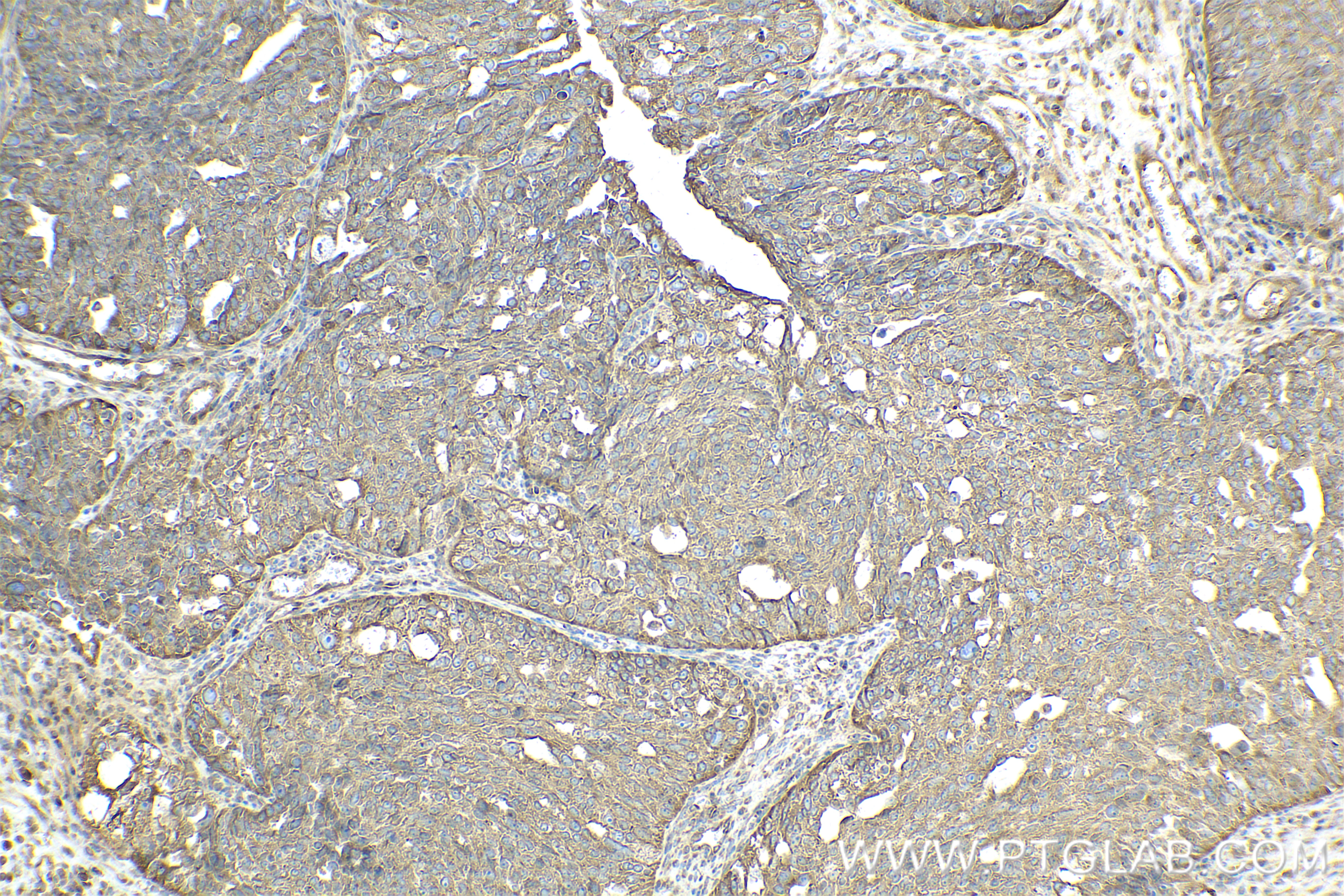IHC staining of human ovary cancer using 83687-4-RR (same clone as 83687-4-PBS)
