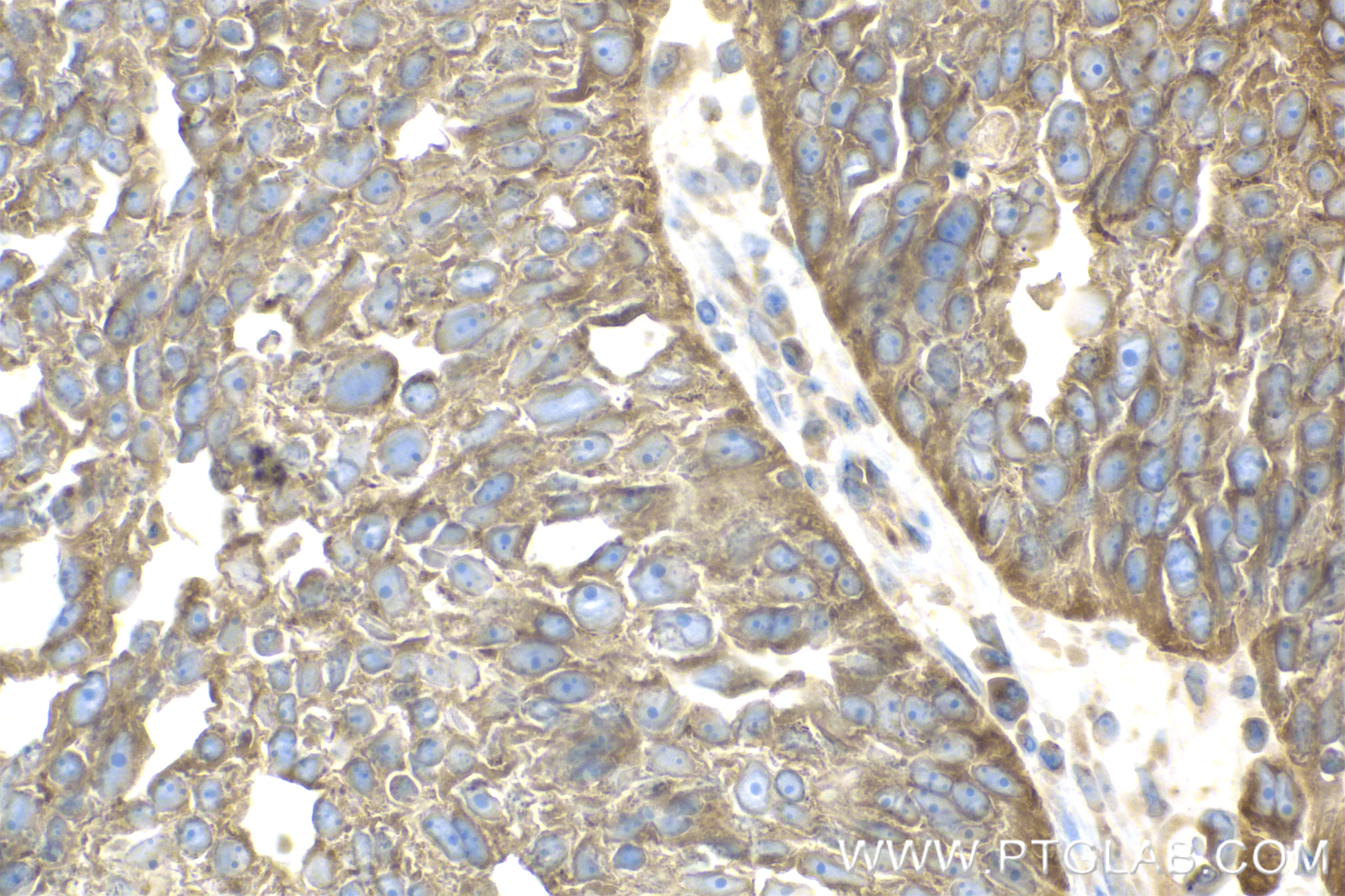 IHC staining of human ovary cancer using 83687-4-RR (same clone as 83687-4-PBS)
