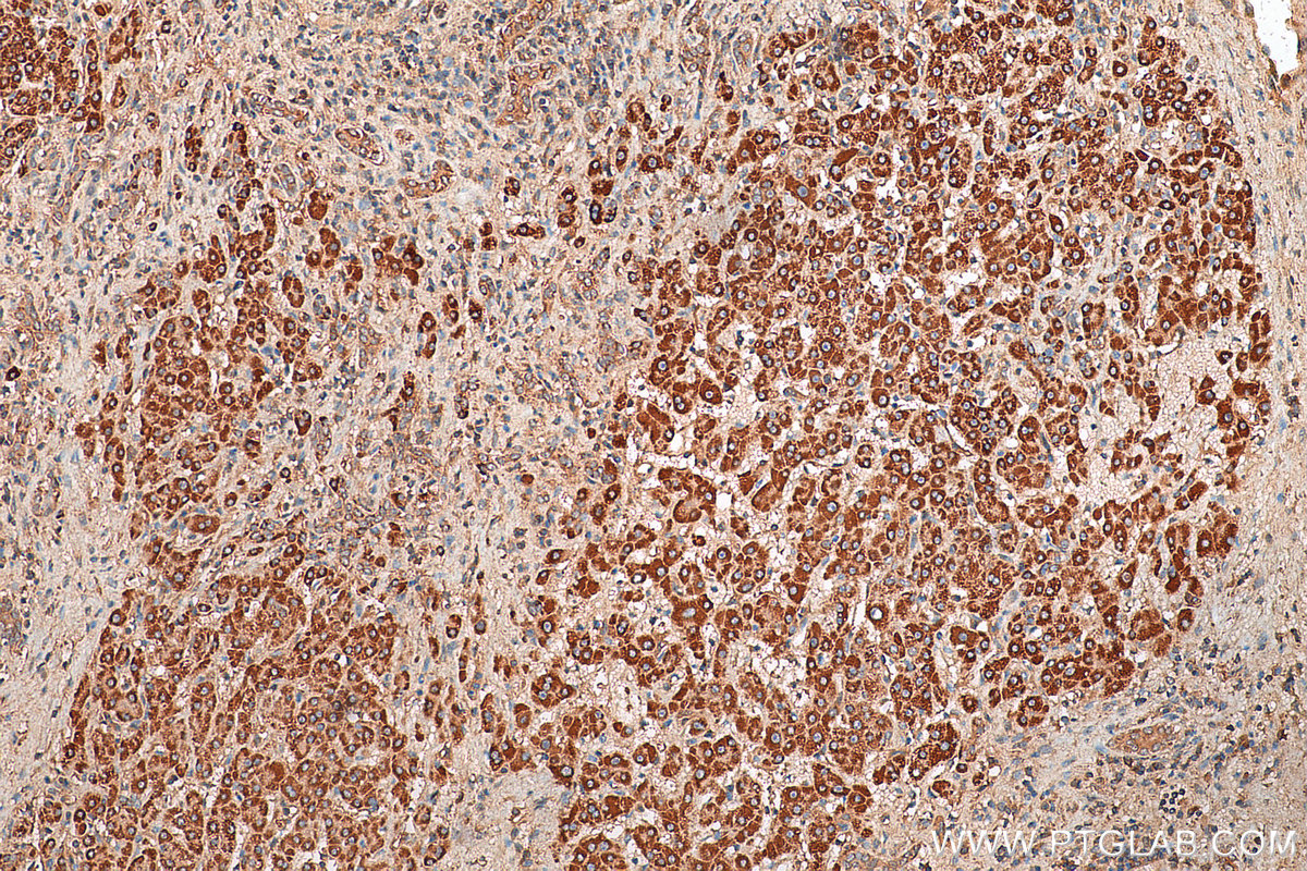 IHC staining of human liver cancer using 29110-1-AP